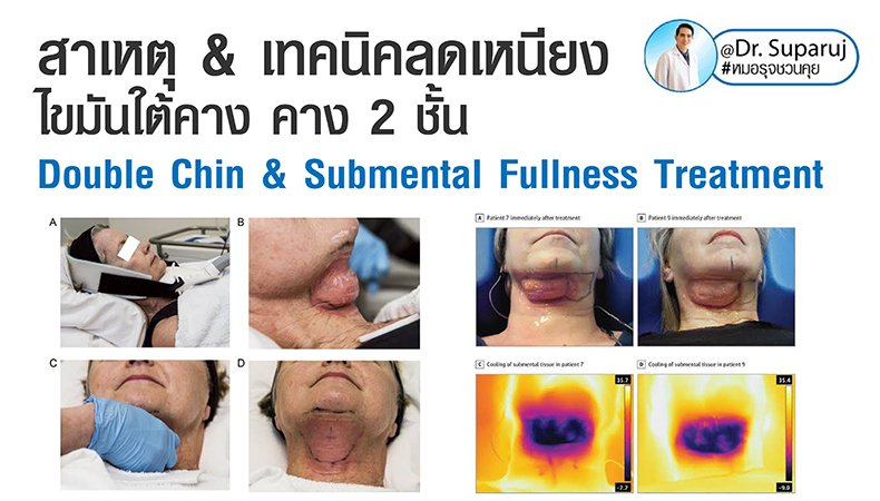 สาเหตุ & เทคนิคลดเหนียง ไขมันใต้คาง คาง 2 ชั้น Double Chin & Submental Fullness Treatment  สาเหตุ & เทคนิคลดเหนียง ไขมันใต้คาง คาง 2 ชั้น Double Chin & Submental Fullness Treatment